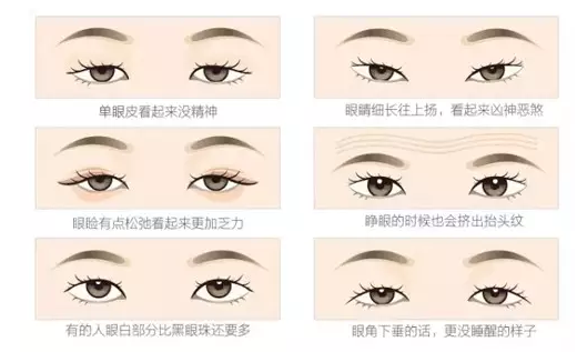 關(guān)于重瞼術(shù)，你要了解的那些事兒