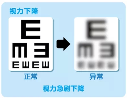 視網(wǎng)膜脫離啥癥狀？這張圖告訴你！