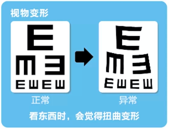 視網(wǎng)膜脫離啥癥狀？這張圖告訴你！