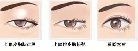為什么要做雙眼皮？5個(gè)理由說(shuō)服你！