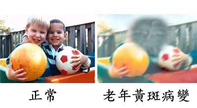 黃斑變性與老花眼，兩者不一樣！