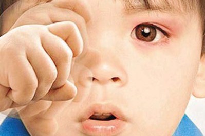 秋季紅眼病高發(fā)，當(dāng)心孩子被傳染