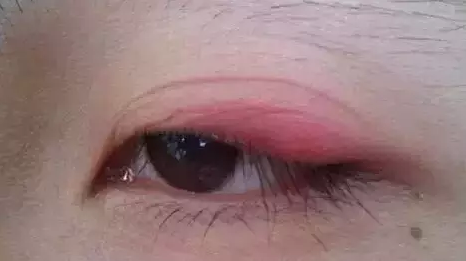 “美目貼”別依賴，小心眼皮下垂