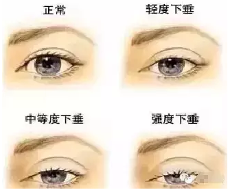 “美目貼”別依賴，小心眼皮下垂