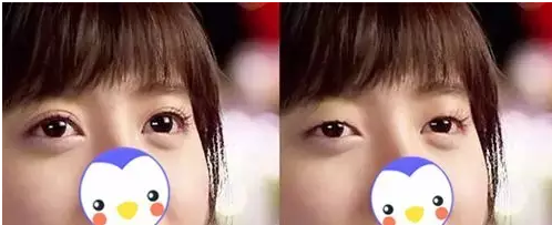 要不要做雙眼皮？別糾結了看這個！