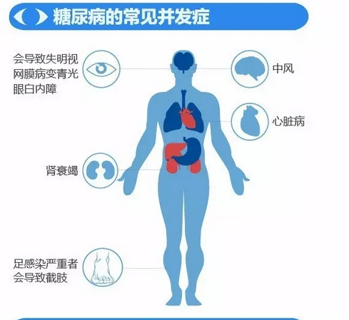 你造嗎？糖尿病晚期眼睛會致盲！