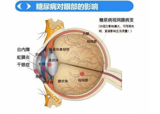 你造嗎？糖尿病晚期眼睛會致盲！