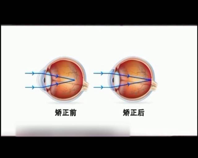 一夜之間真的能改變視力嗎？