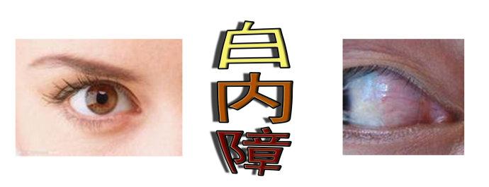 白內(nèi)障手術(shù)會反復(fù)嗎？