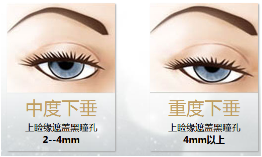 拯救惺忪睡眼，告別上瞼下垂！