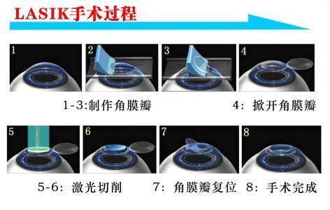 他們很有錢，但寧愿戴眼鏡都不做近視手術(shù)