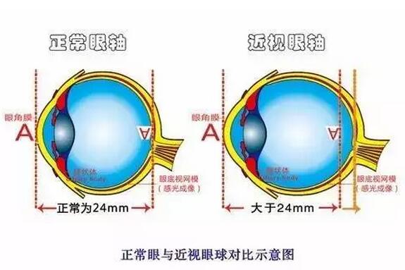 近視超過(guò)600度以上？這7條“錦囊”請(qǐng)收好！