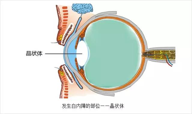 眼科主任告誡白內(nèi)障這幾大誤區(qū)，80%的老人上當(dāng)