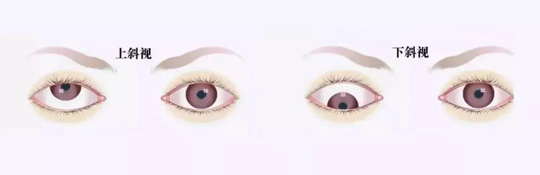 關(guān)于斜視，這幾個誤區(qū)害人不淺!
