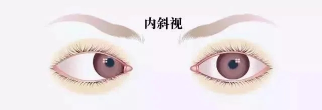 關(guān)于斜視，這幾個誤區(qū)害人不淺!
