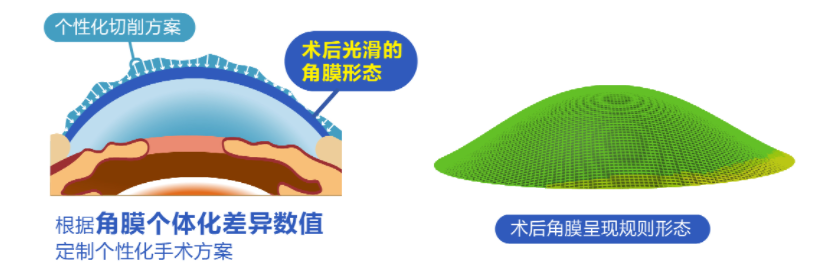 微雕優(yōu)視飛秒，重新定義角膜屈光手術(shù)，讓視力多看一行！